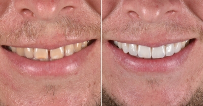 Facetas dentárias: tratamento entrega sorriso perfeito na hora, mas dor de cabeça a longo prazo