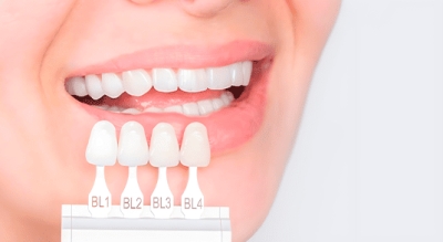 Facetas e lentes dentais: est&eacute;tica, sa&uacute;de e informa&ccedil;&atilde;o